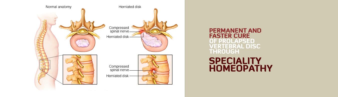 Prolapsed Vertebral Disc