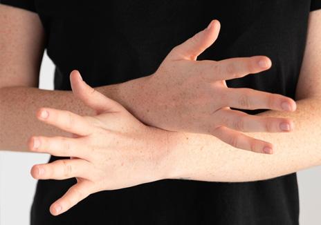 Atopic Dermatitis